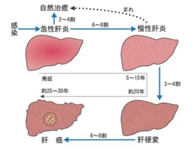 C型肝硬変